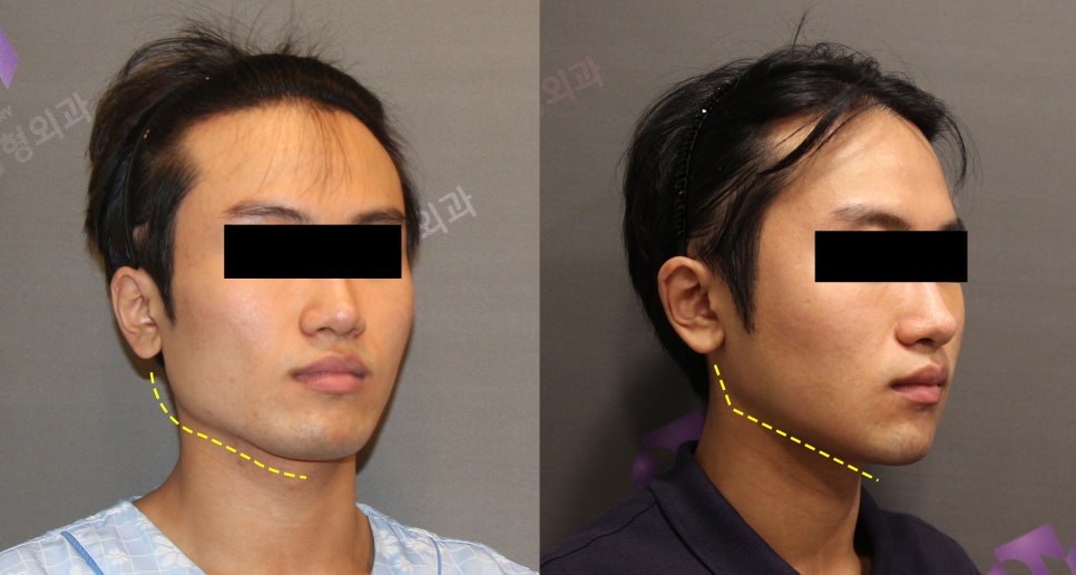 남자사각턱, 남자다운 턱선이 중요한 안면윤곽수술 관련 이미지 6