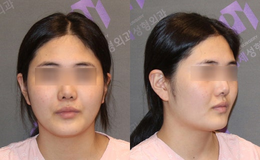 Will Jawline Surgery Make the Face’s Jawline More Defined? image 3