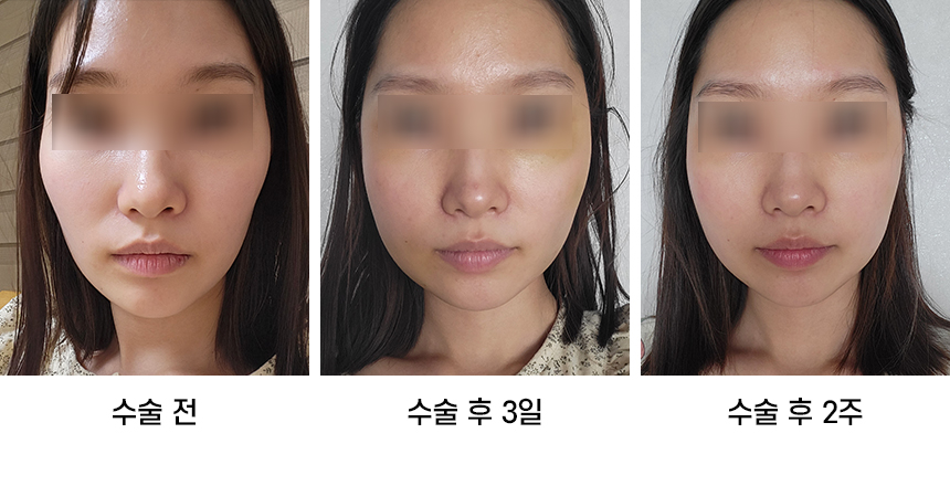 Do Not Confuse Facial Contouring Sagging with Swelling! image 1