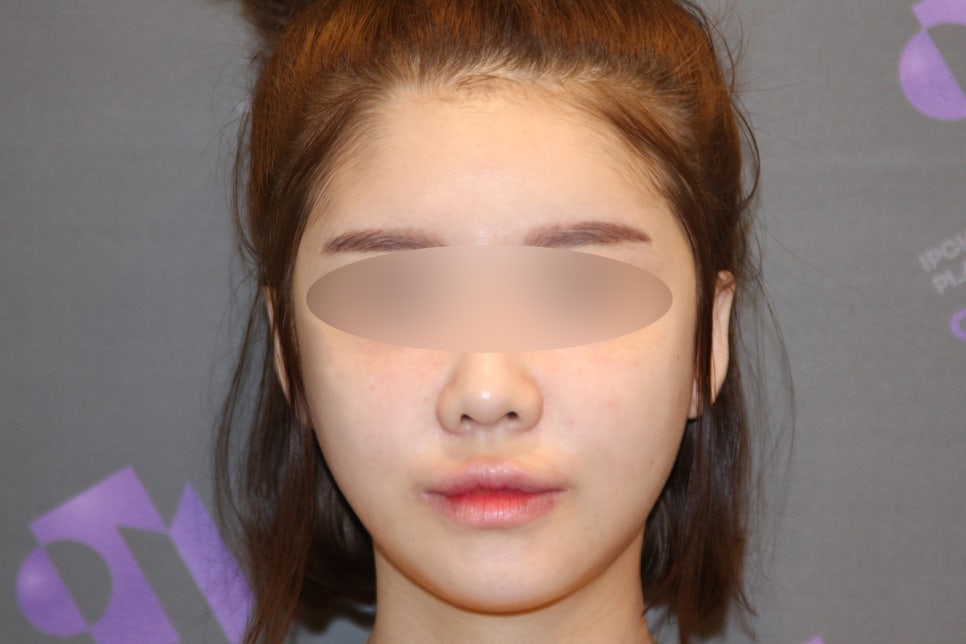 안면윤곽, 연예인 신세경처럼 예뻐질수 있을까요? -전문의가 알려드립니다. 관련 이미지 3