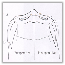 Zygoma Reduction Surgery: Quick Zygoma vs. 3D Zygoma Surgery Differences in Effect and Selection Criteria image 1