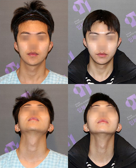 얼굴 비대칭, 한쪽만 윤곽수술 할 수 있나요? 관련 이미지 1