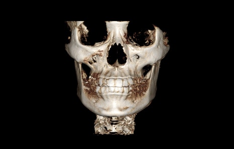 Square Jaw Surgery: What Are a Retracted Jaw and a Protruding Jaw? image 8