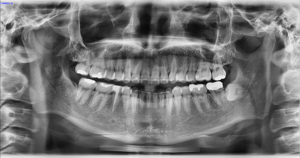 [Chin Surgery] Learning About Contouring Shave and T-Osteotomy with Real Patient Cases (2) image 6