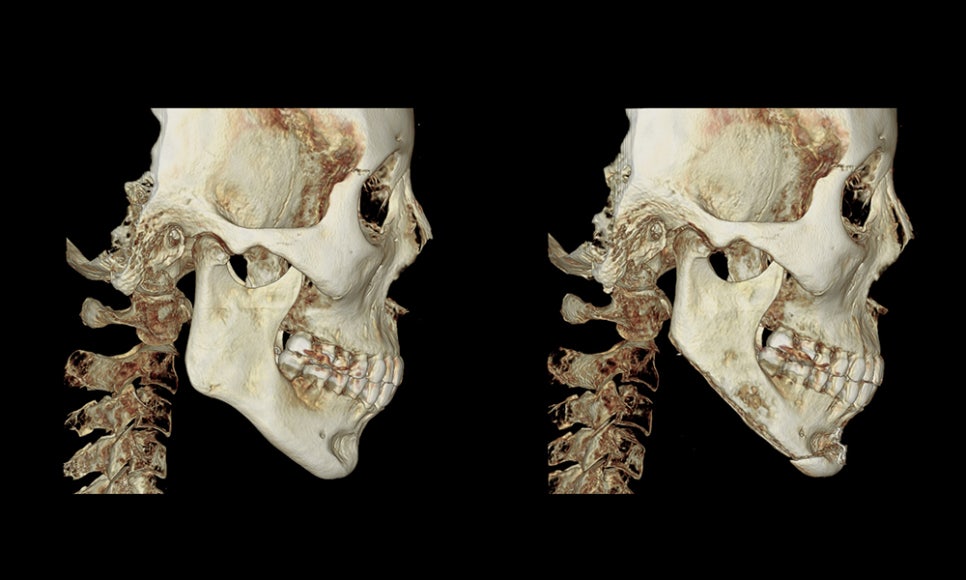 What Surgery Is Best for Correcting a Short Chin or Recessed Chin? The Limits of Chin Surgery and the Actual Results image 4