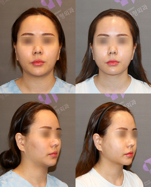 The Story After Cheek Dimple Correction image 4