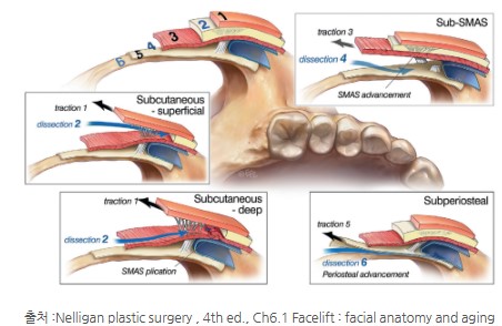 Facelift Q&A (1): The Truth and Myth of the SMAS Fascia image 2