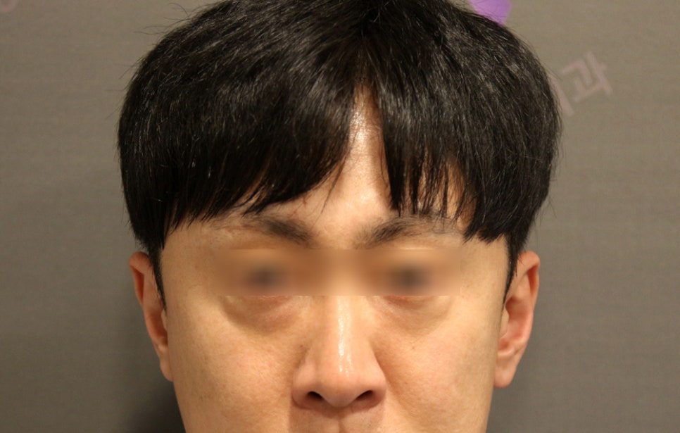 [칼럼] 다크서클 없애는 법 : 눈밑지방제거, 눈밑지방재배치 수술 관련 이미지 2