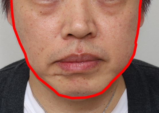 Amazing Changes Achieved with Contouring Facelift: A Facelift Technique That Even Addresses Asymmetry image 1