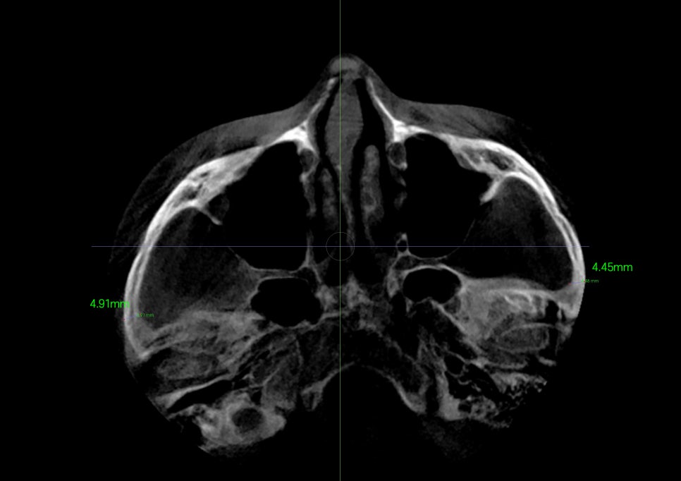 Will cheekbone reduction surgery also make the face smaller? : Learn about how to reduce prominent cheekbones with real surgical cases image 3