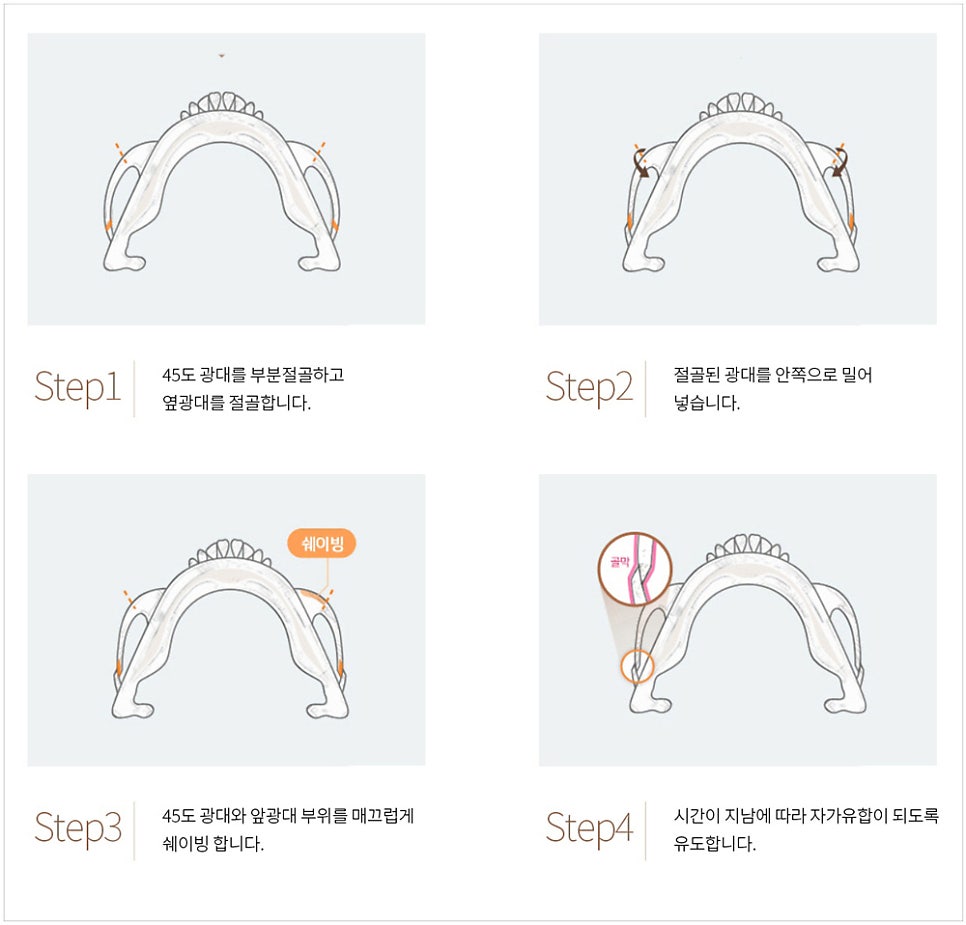 230도입체광대가 3D광대축소술보다 더 좋은가요? 관련 이미지 2