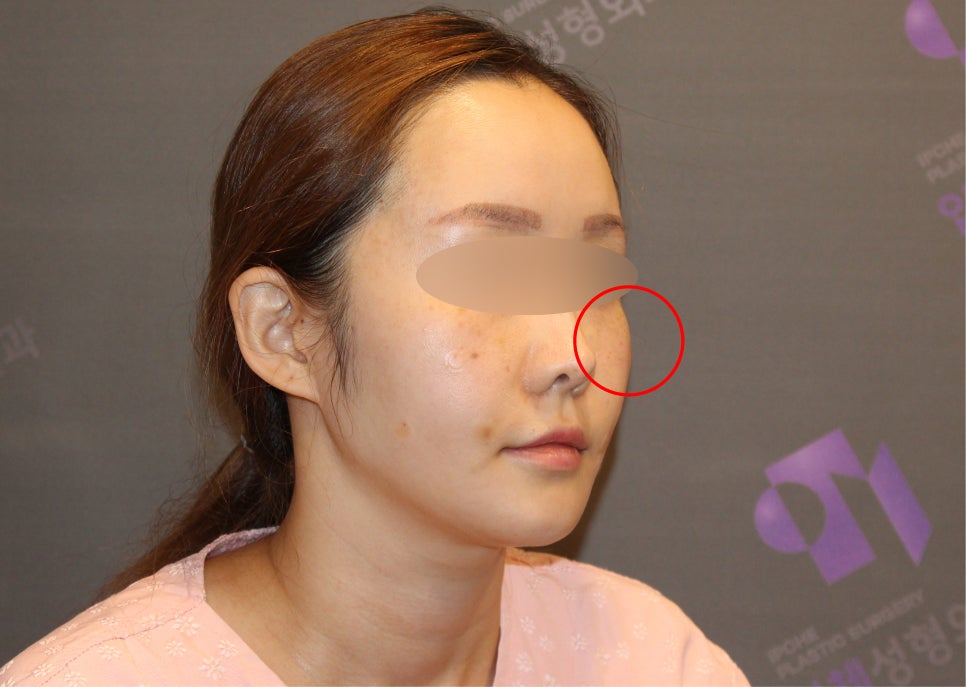 옆광대수술후기, 사례와 함께 알아보기 - 전문의가 직접알려드립니다. 관련 이미지 1