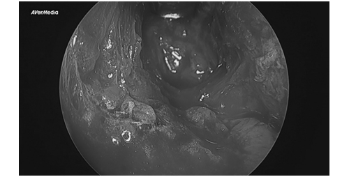 Considering revision cheekbone surgery, is it possible with a 230-degree three-dimensional cheekbone reduction as well? image 6