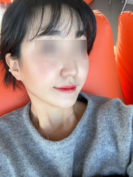 How Long Do Facial Contour Changes Continue After Facial Bone Contouring Surgery? (Day 1 to Day 365) — See With Photos image 8