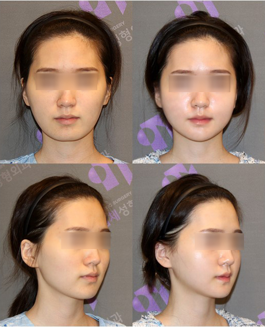 안면윤곽 연예인 고윤정, 카리나 얼굴형처럼 예뻐질 수 있을까요? 관련 이미지 8