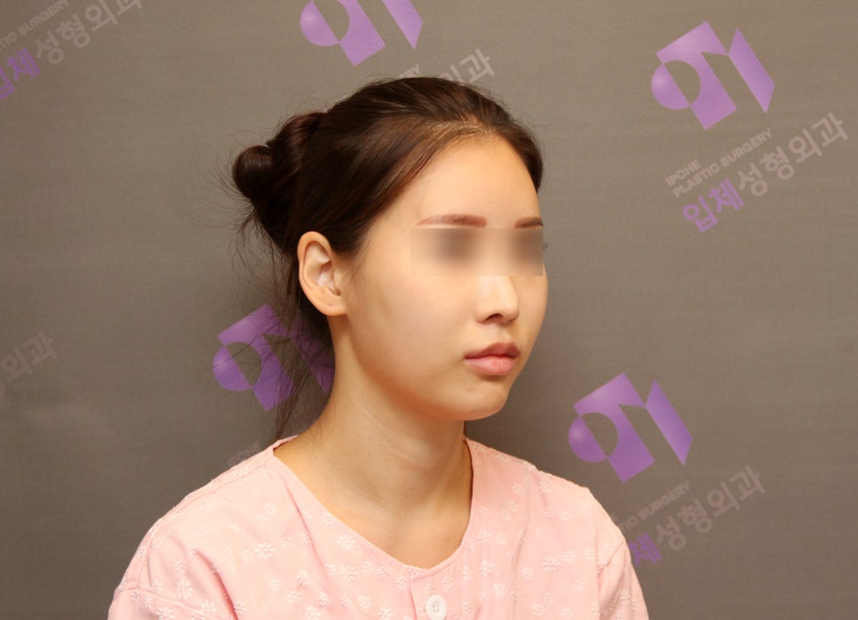 Review of Side Cheekbone Reduction Surgery image 2