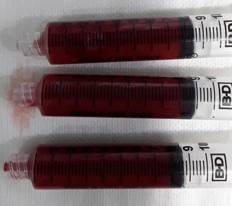 Forehead Fat Grafting Side Effects: Is There a Way to Remove Excess Fat? image 3