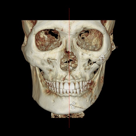 When Are Facial Contouring Surgery and Facelift Surgery Needed Together? image 1