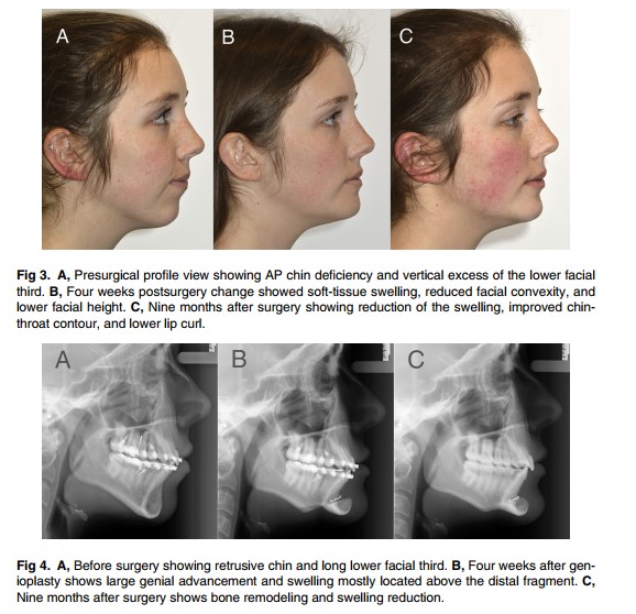 [Paper Review] The Relationship Between Forward Movement of the Chin Bone and Soft Tissue Movement: After Chin Advancement Surgery, How Will My Face Actually Change? image 10