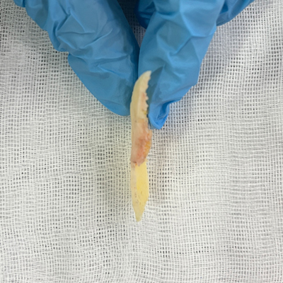 Are There People Who Can’t Have Cortical Ostectomy Surgery for a Frontal Square Jaw Effect? image 5
