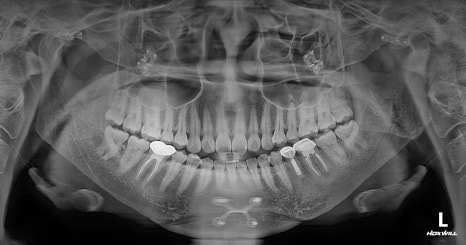 Are There Cases Where Pin Removal Is Difficult After Double Jaw or Contouring Surgery? image 2