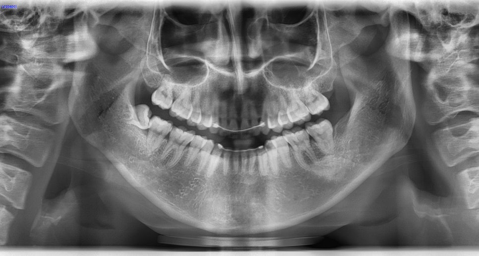 Long Chin, Long Face Contouring - Cases That Do Not Require Double Jaw Surgery image 5