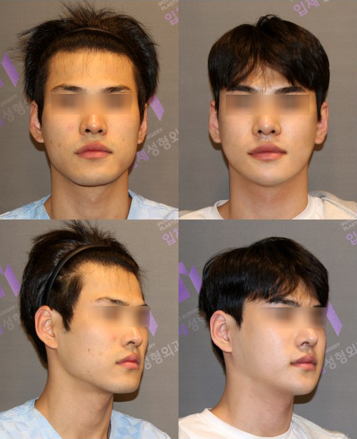 Why Is Male Cheekbone Reduction Different from Female Cheekbone Reduction? image 9