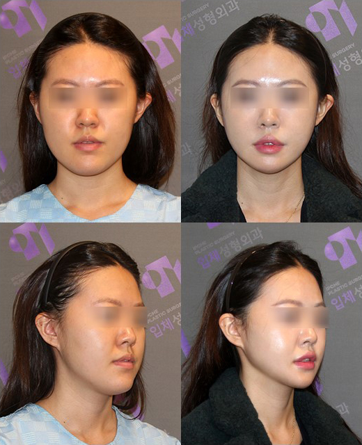 긴턱 교정은 어떤 수술이 좋을까요? 턱끝축소술의 한계와 실제 결과 관련 이미지 14