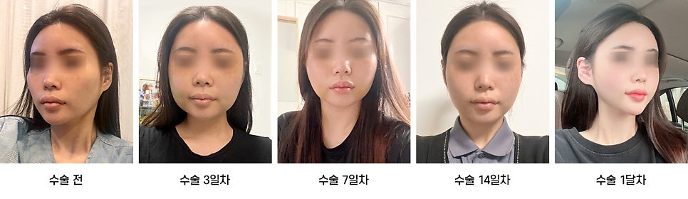 안면윤곽 수술 후 붓기, 일상생활은 언제부터 가능한가요? 케이스별로 알아보기 관련 이미지 5