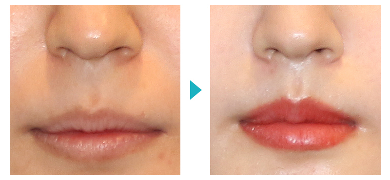 Surgery That Shortens the Midface Without Double Jaw Surgery: Philtrum Reduction Surgery image 5