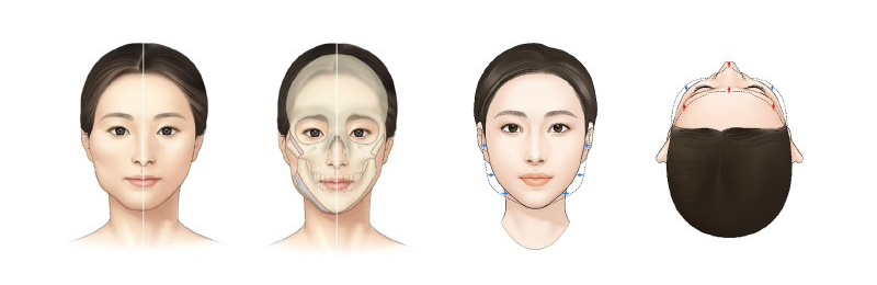 [논문 리뷰] 아시아인 안면윤곽수술에 대해서 관련 이미지 4