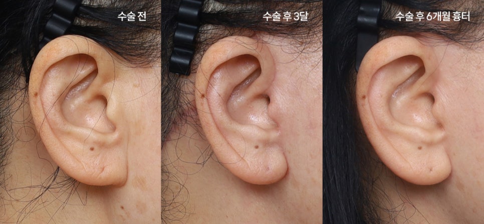 안면거상 수술의 적절한 시기: 얻는 것과 감수해야 할 것 관련 이미지 2