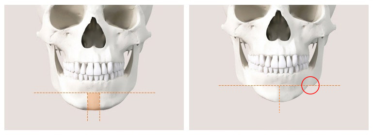 Is There a Way to Address the Secondary Angle That Appears After Chin Surgery? image 1