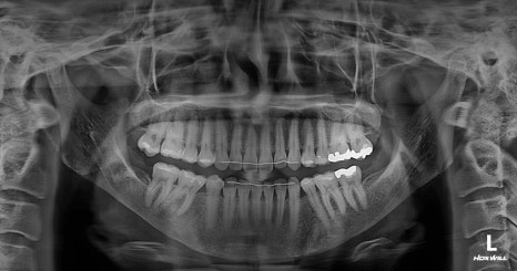Long Midface and Lower Face Long-Face, Long-Chin Surgery - Cases That Do Not Require Double-Jaw Surgery image 10