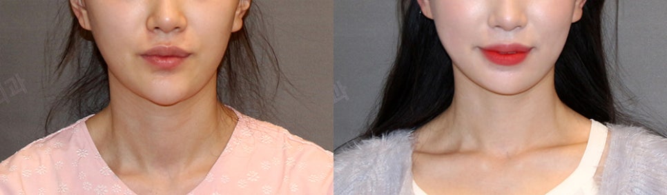 How Should Witch Chin Be Treated When You Smile? image 5