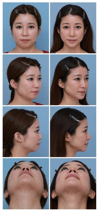 [Paper Review] The Extended Zygoma Reduction Surgery Recently in Vogue in Japan image 6