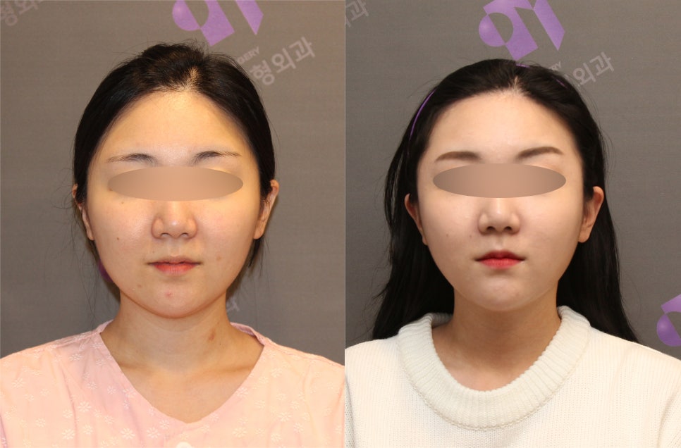 안면윤곽수술비용, 비쌀수록 좋은걸까요? -전문의가 알려드립니다. 관련 이미지 9