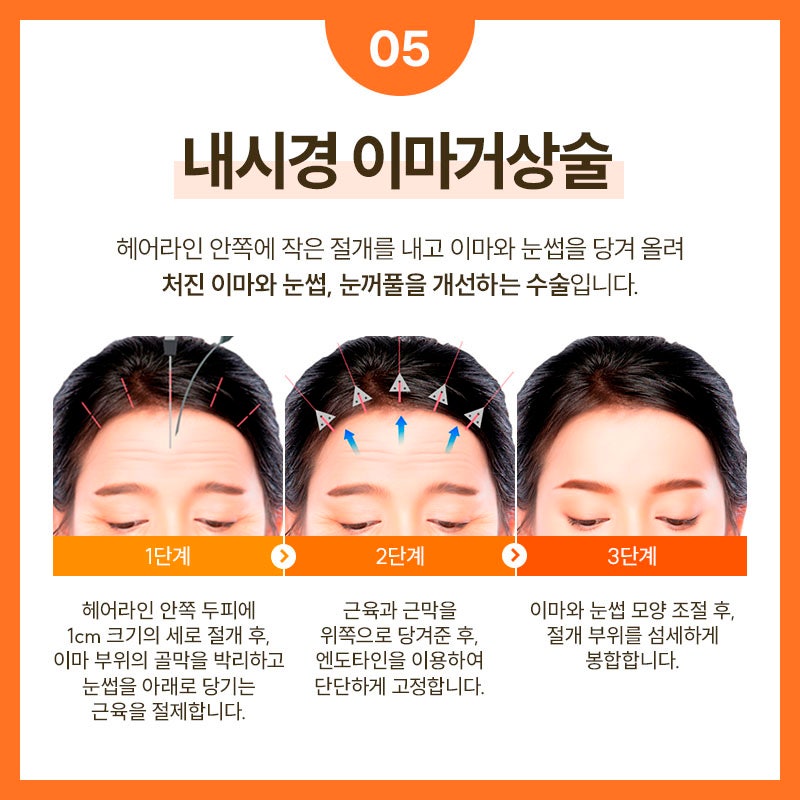 SMAS Facelift Effective for Improving Facial Sagging and Wrinkles image 6