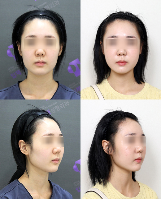 광대축소술 후 긴얼굴이 더 길어 보일까요? 관련 이미지 4