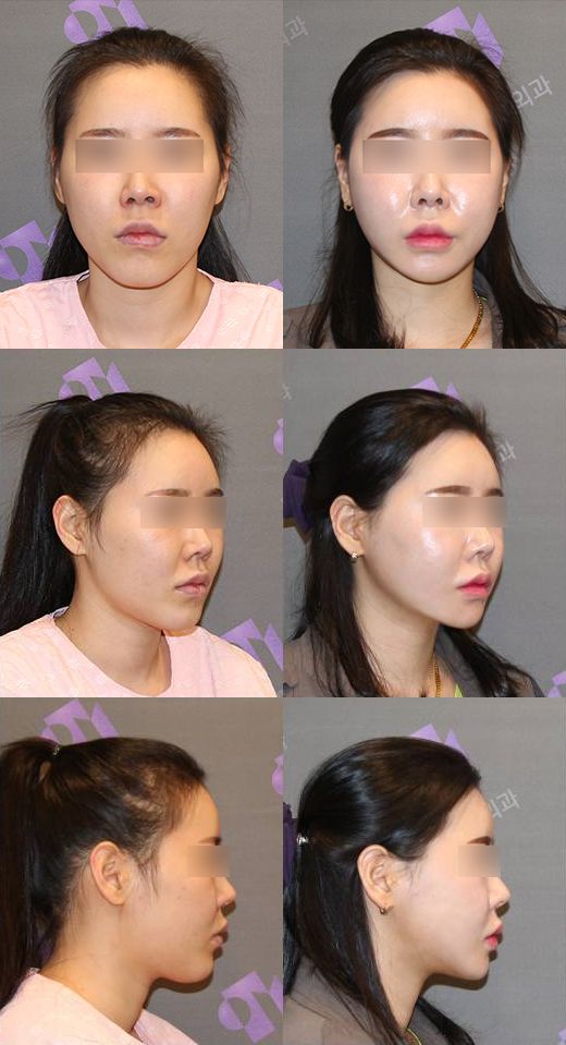 [긴턱/주걱턱교정] 돌려깎기와 턱끝T절골수술, 이차각 부작용은 왜 생기는 걸까요? 관련 이미지 2