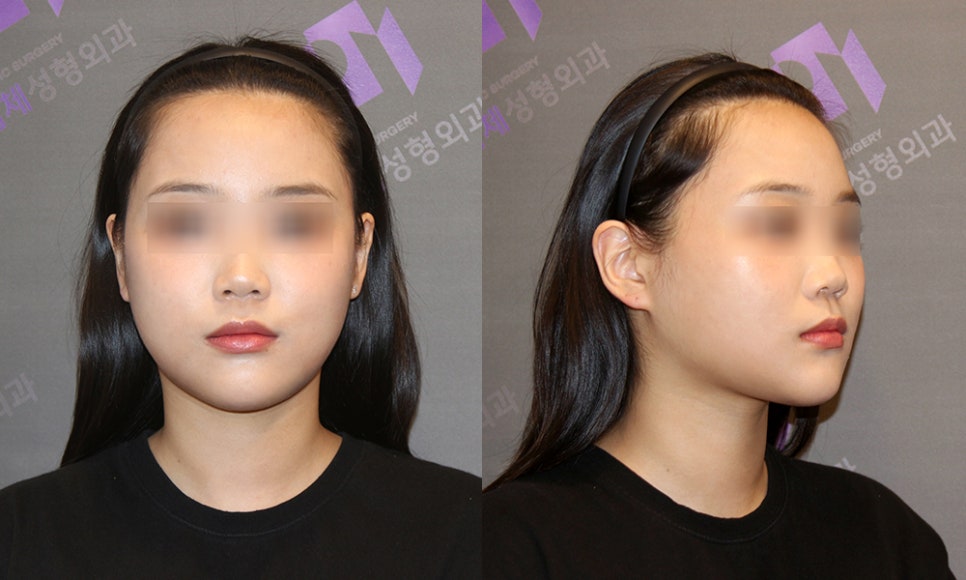 Does the Surgical Method Change Depending on the Protruding Cheekbone Location? Exact Locations and Diagnosis of the Front Cheekbone, Side Cheekbone, 45-Degree Cheekbone, and Back Cheekbone image 5