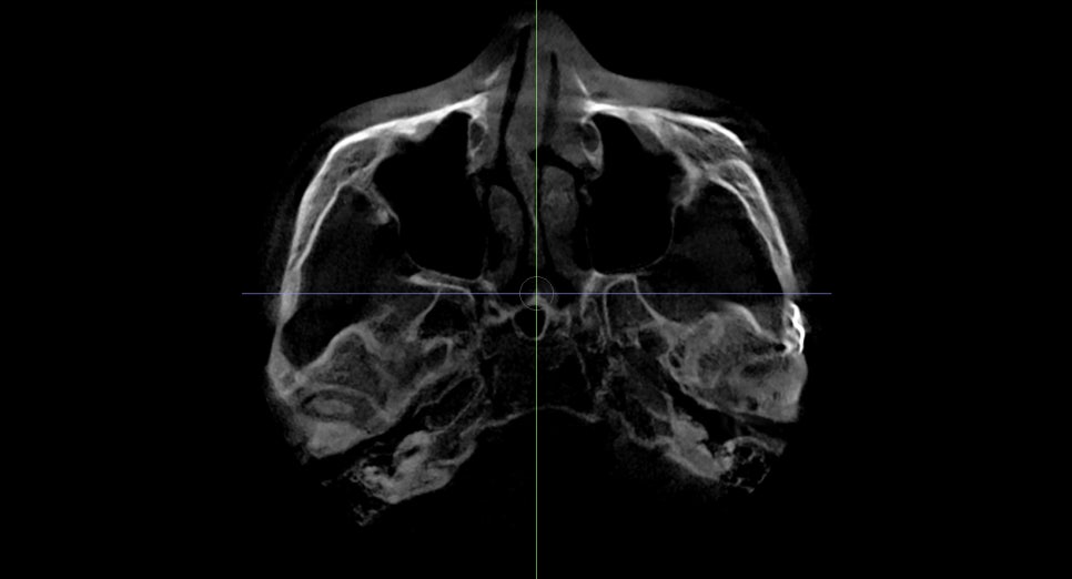 Back Cheekbone Shaving? Osteotomy? Do You Really Need It? image 11
