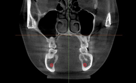 Are There People Who Can’t Have Cortical Ostectomy Surgery for a Frontal Square Jaw Effect? image 2