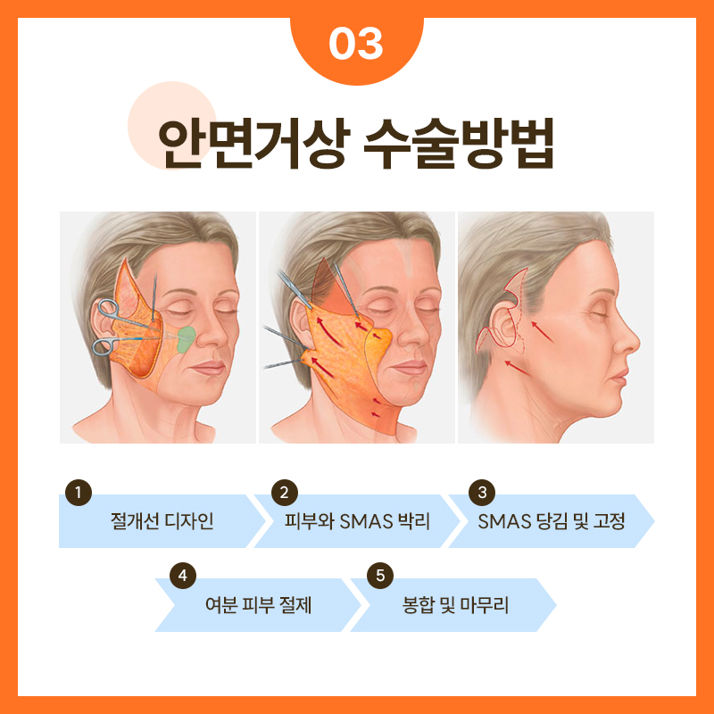 SMAS Facelift Effective for Improving Facial Sagging and Wrinkles image 4