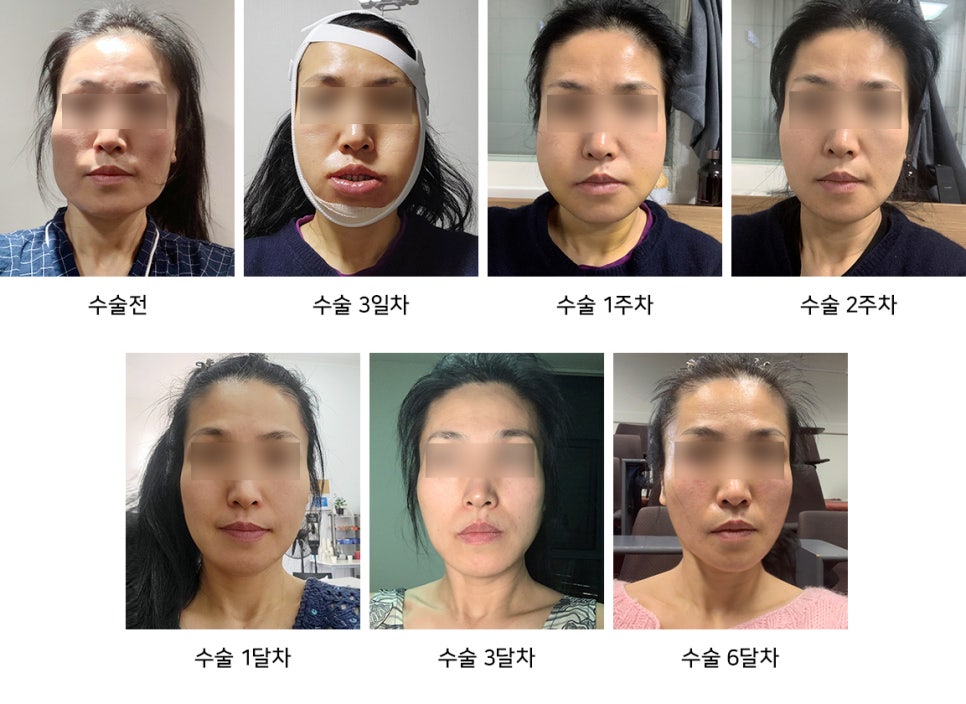 안면윤곽수술 50대에 받아도 될까요? 꼭 알아둬야 할 사항들 관련 이미지 11