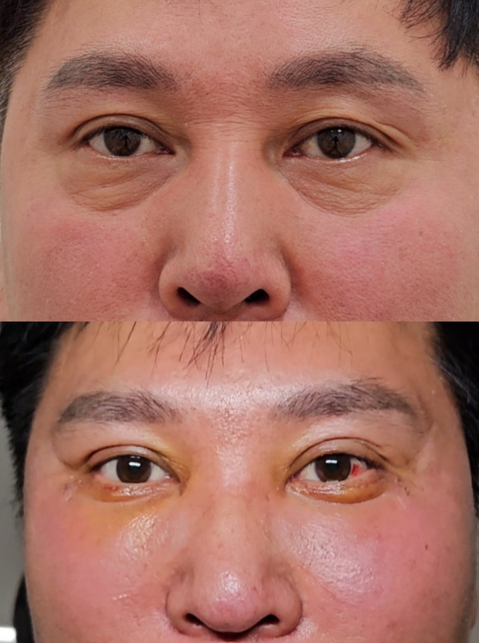 The Evolution of Fourth-Generation Lower Blepharoplasty - Midface Lift (Cheek Lift) and Apple Cheeks image 4