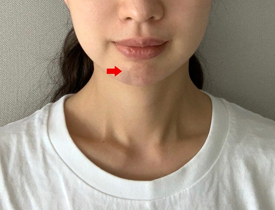 What Procedures Are Good to Have After Facial Contouring Surgery? image 2