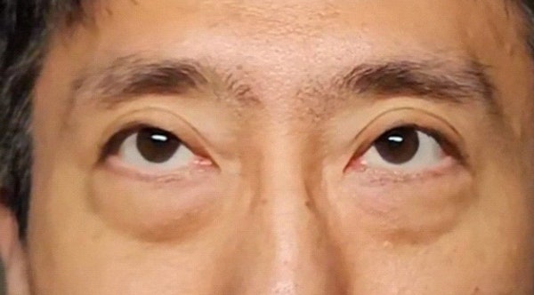 50대 남자눈성형 하안검 수술 케이스 - 세대별 분석으로 접근한 해결 전략 관련 이미지 1