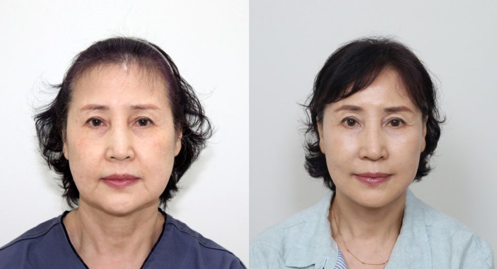 The Importance of Buccal Fat Removal in Facelift Surgery image 5
