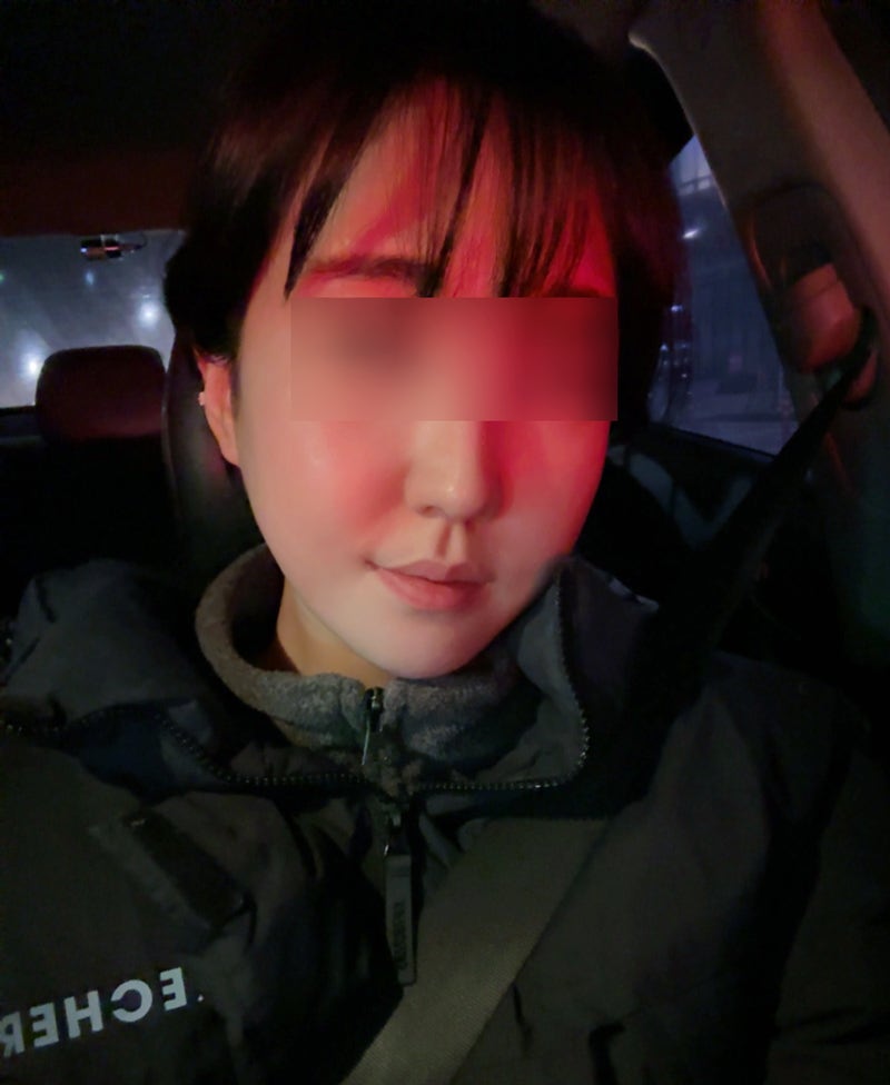 How Long Do Facial Contour Changes Continue After Facial Bone Contouring Surgery? (Day 1 to Day 365) — See With Photos image 9